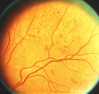 Diabetic retina