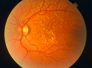 Macular degeneration